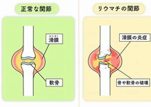 関節リウマチ