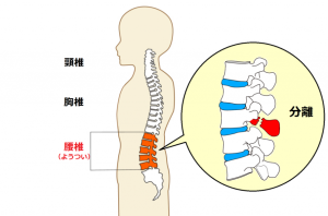 分離症