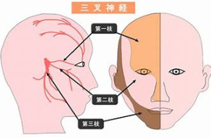 三叉神経痛