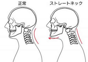 ストレートネック